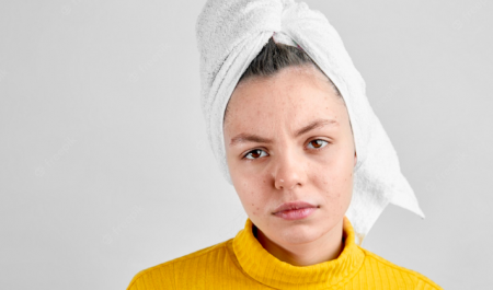 สิวยีสต์ สิวเชื้อรา คืออะไร รักษาอย่างไรให้หายขาด