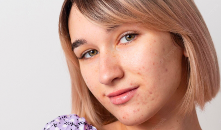 หลุมสิว เกิดจากอะไร? มีวิธีรักษาหรือลดโอกาสการเกิดไหม?