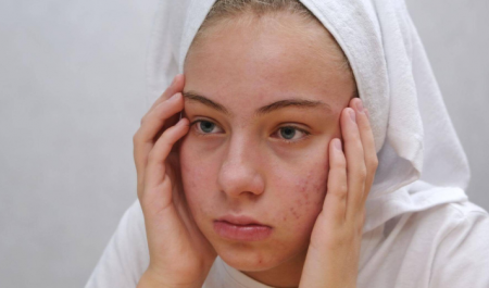 สิวฮอร์โมน เจาะลึกถึงสาเหตุและวิธีการรักษา