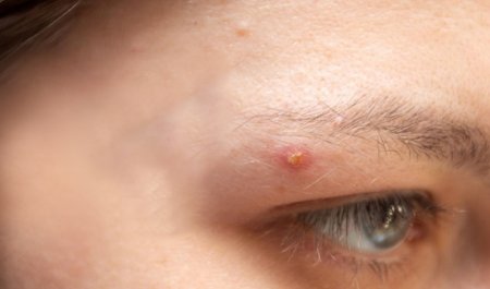 สิวขึ้นคิ้ว สิวขึ้นระหว่างคิ้ว เกิดจากอะไร พร้อมวิธีแก้ไข