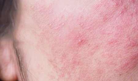 หน้าแพ้ครีม มีอาการเป็นอย่างไร และมีวิธีรักษาอย่างไรบ้าง
