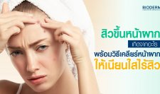 สิวขึ้นหน้าผากเกิดจากอะไร? พร้อมวิธีเคลียร์หน้าผากให้เนียนใสไร้สิว