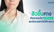 สิวขึ้นคางเกิดจากอะไร? มีวิธีป้องกันและรักษาอย่างไรให้หายขาด