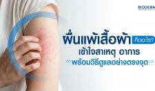 ผื่นแพ้เสื้อผ้าคืออะไร? เข้าใจสาเหตุ อาการ พร้อมวิธีดูแลอย่างตรงจุด