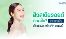 สิวสเตียรอยด์คืออะไร เกิดจากอะไร รักษาอย่างไรให้หายขาด?