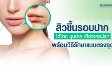 สิวขึ้นรอบปาก ใต้ปาก มุมปาก เกิดจากอะไร? พร้อมวิธีรักษาแบบตรงจุด