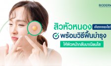 สิวหัวหนองเกิดจากอะไร? พร้อมวิธีฟื้นบำรุงให้ผิวหน้ากลับมาเนียนใส