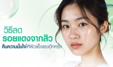 วิธีลดรอยแดงจากสิว คืนความมั่นใจให้ผิวแข็งแรงอีกครั้ง