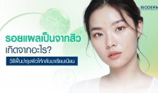รอยแผลเป็นจากสิวเกิดจากอะไร? วิธีฟื้นบำรุงผิวให้กลับมาเรียบเนียน