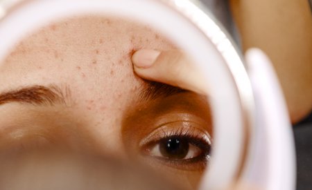 Bioderma - Acne dysseborrhoea
