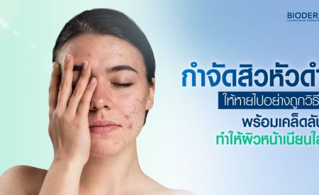 กำจัดสิวหัวดำให้หายไปอย่างถูกวิธี พร้อมเคล็ดลับทำให้ผิวหน้าเนียนใส