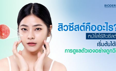 สิวซีสต์คืออะไร? หน้าใสไร้สิวซีสต์ เริ่มต้นได้ที่การดูแลตัวเองอย่างถูกวิธี
