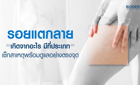 รอยแตก คือรอยที่เกิดจากการยืดหรือหดตัวของผิวหนังอย่างรวดเร็ว จนโครงสร้างเกิดฉีกขาดกะทันหัน เมื่อผิวซ่อมแซมตัวเองจึงขึ้นเป็นเส้นริ้วมีสีต่างกันตามสภาพผิว