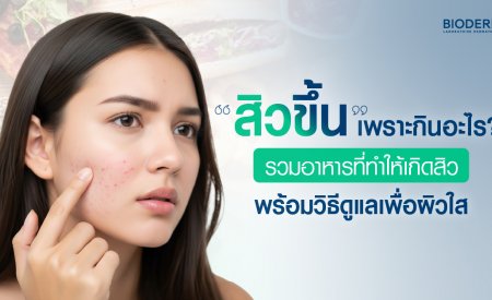 สิวขึ้นเพราะกินอะไร? รวมอาหารที่ทำให้เกิดสิว พร้อมวิธีดูแลเพื่อผิวใส