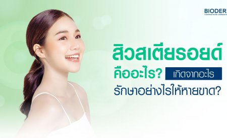 สิวสเตียรอยด์คืออะไร เกิดจากอะไร รักษาอย่างไรให้หายขาด?