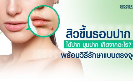 สิวขึ้นรอบปาก ใต้ปาก มุมปาก เกิดจากอะไร? พร้อมวิธีรักษาแบบตรงจุด