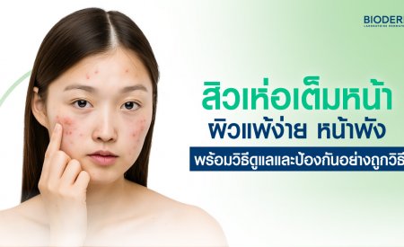 สิวเห่อเต็มหน้า ผิวแพ้ง่าย หน้าพัง พร้อมวิธีดูแลและป้องกันอย่างถูกวิธี