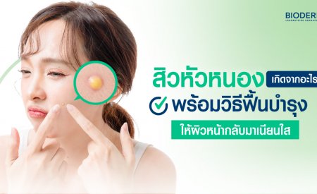 สิวหัวหนองเกิดจากอะไร? พร้อมวิธีฟื้นบำรุงให้ผิวหน้ากลับมาเนียนใส
