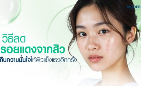 วิธีลดรอยแดงจากสิว คืนความมั่นใจให้ผิวแข็งแรงอีกครั้ง