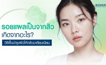 รอยแผลเป็นจากสิวเกิดจากอะไร? วิธีฟื้นบำรุงผิวให้กลับมาเรียบเนียน