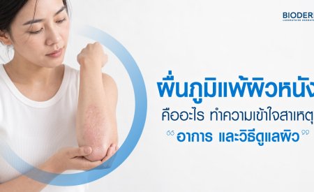ผื่นภูมิแพ้ผิวหนังคืออะไร ทำความเข้าใจสาเหตุ อาการ และวิธีดูแลผิว