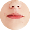 Acne level 0