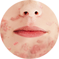 Acne level 4