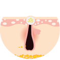 Microcyst