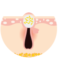 Papule