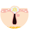 Pustule