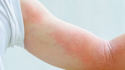 A child's arms with red plaques related to allergic contact dermatitis.