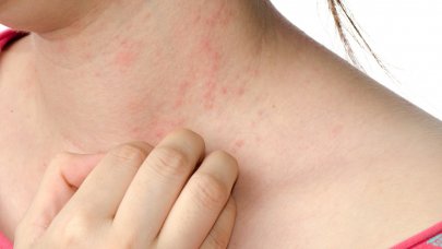 A photo of a neck with chronic urticaria patches