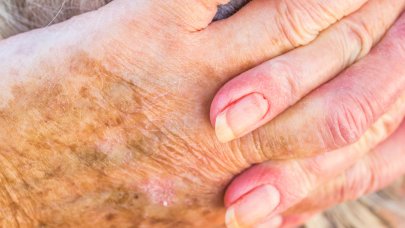 A photo of a hand suffering from senile xerosis