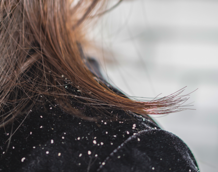 dandruff on shoulder