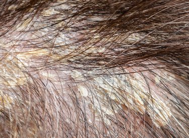 seborrheic dermatitis on the scalp seborrheic dermatitis on the scalp