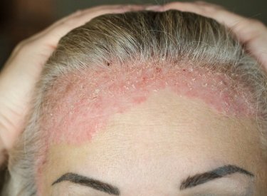 psoriasis on forehead and scalp psoriasis on forehead and scalp