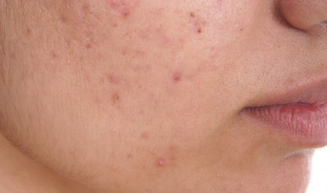 Bioderma - Acne Oily Skin