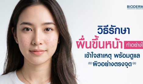วิธีรักษาผื่นขึ้นหน้าทำอย่างไร เข้าใจสาเหตุ พร้อมดูแลผิวอย่างตรงจุด
