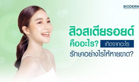 สิวสเตียรอยด์คืออะไร เกิดจากอะไร รักษาอย่างไรให้หายขาด?
