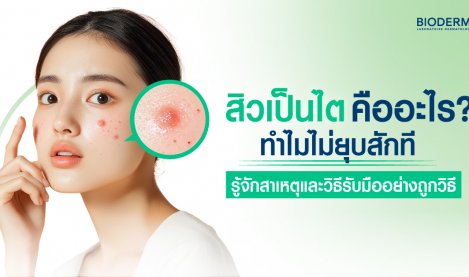 สิวเป็นไตคืออะไร? ทำไมไม่ยุบสักที รู้จักสาเหตุและวิธีรับมืออย่างถูกวิธี