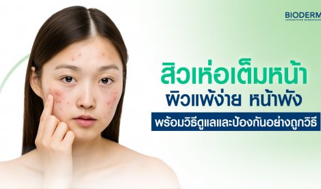 สิวเห่อเต็มหน้า ผิวแพ้ง่าย หน้าพัง พร้อมวิธีดูแลและป้องกันอย่างถูกวิธี