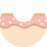 Hollow scar
